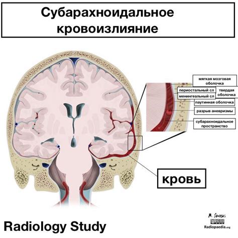 Симптомы кровоизлияния в голове