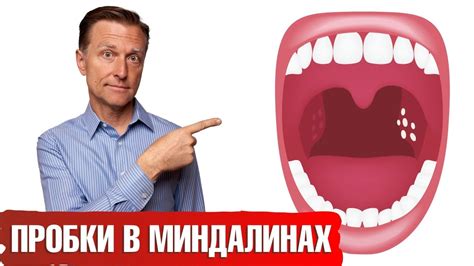 Симптомы нароста на гландах