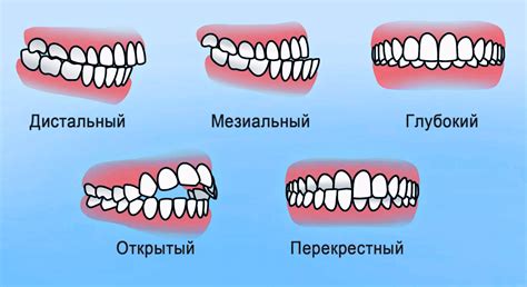 Симптомы нарушения прикуса у ребенка