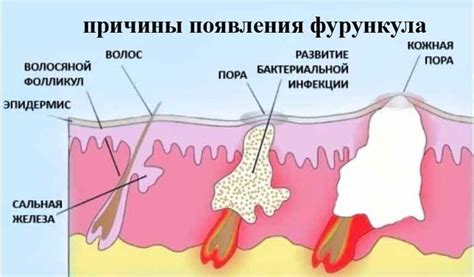 Симптомы нарыва под мышкой