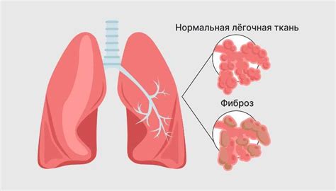 Симптомы ограниченного дыхания