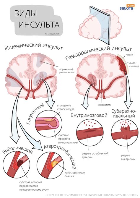 Следствия головного инсульта