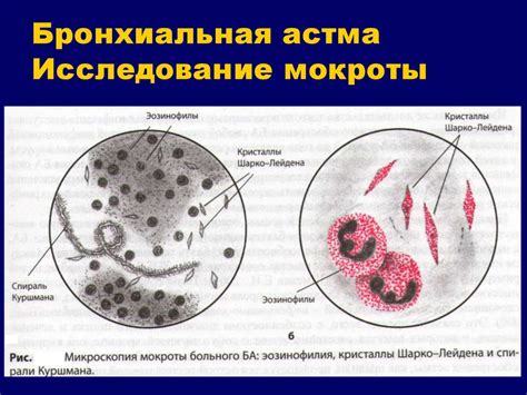 Состав мокроты при бронхиальной астме