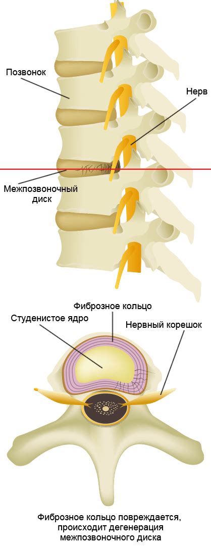 Состояние межпозвоночных дисков