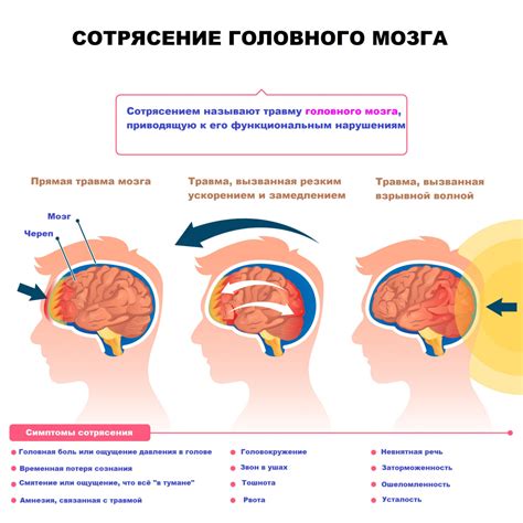 Сотрясение мозга: ключевая информация