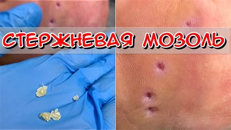 Способы быстрого облегчения при мокрой мозоли