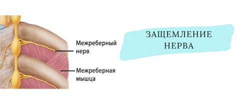 Способы снятия дискомфорта при межреберной невралгии слева