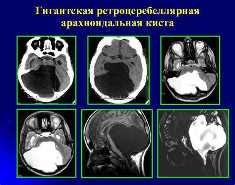 Сравнение различных методов экстракции арахноидальной кисты: анализ эффективности и характеристик