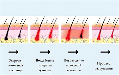 Сравнение стоимости процедур удаления нежелательных волос