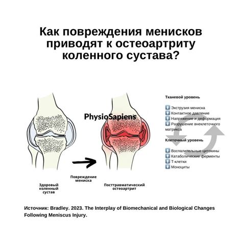 Сущность повреждения менискового бокситра коленного сустава