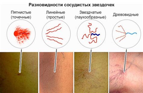 Татуировки и сосудистые звездочки: факты и мифы