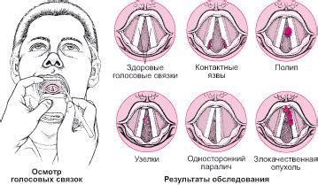 Техника использования голосовых связок