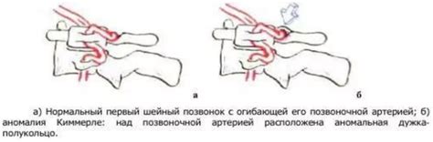 Техники массажа при аномалии Киммерли