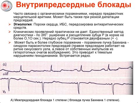 Типичные ЭКГ-признаки нарушения внутрипредсердной проводимости