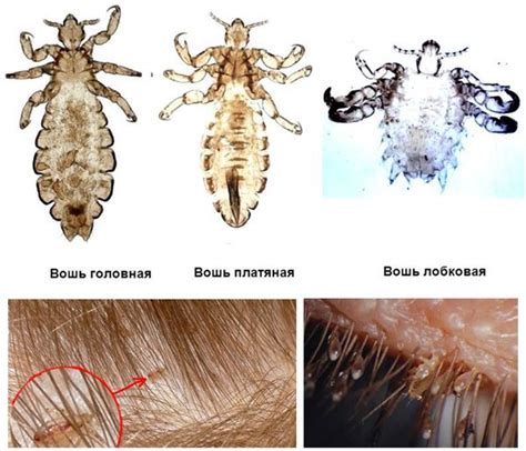 Типичные места обитания головных и лобковых вшей