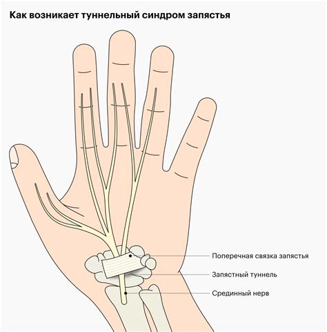 Туннельный синдром запястья: поражение нервов