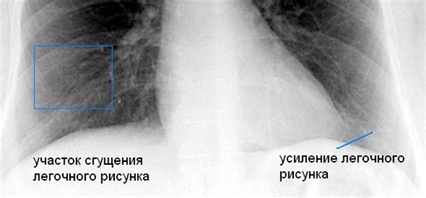 Увеличение объема легких у курильщиков дома