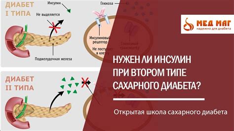 Улучшение и сохранение устойчивого состояния при втором типе диабета