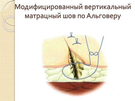 Уход за швами после родов