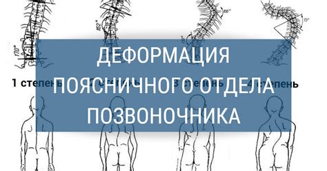 Факторы, влияющие на нарушение статики позвоночного столба