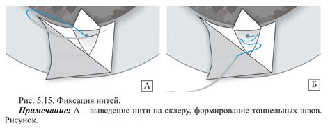 Фиксация конечных нитей