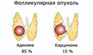 Фолликулярная опухоль щитовидной железы: важная информация