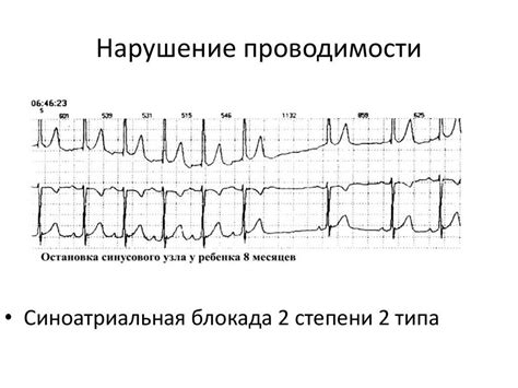 Частые нарушения внутрипредсердной проводимости