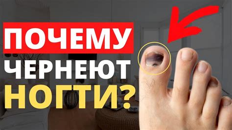 Черный ноготь на ноге