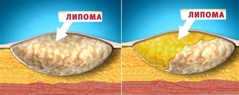 Что такое жировик и как происходит его удаление