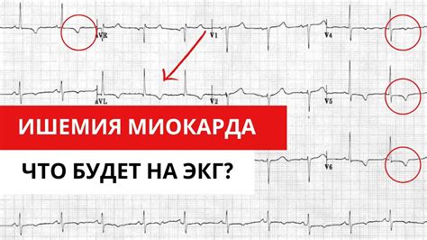 ЭКГ в плане лечения: как результаты помогают назначить правильную терапию