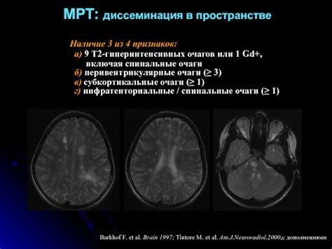 Этиология гиперинтенсивных очагов