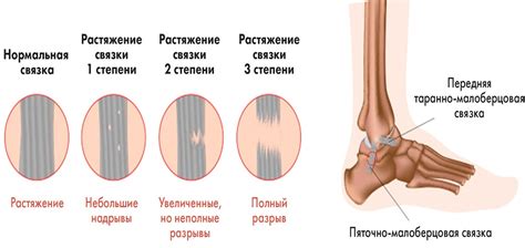 Эффективное лечение растяжения связок