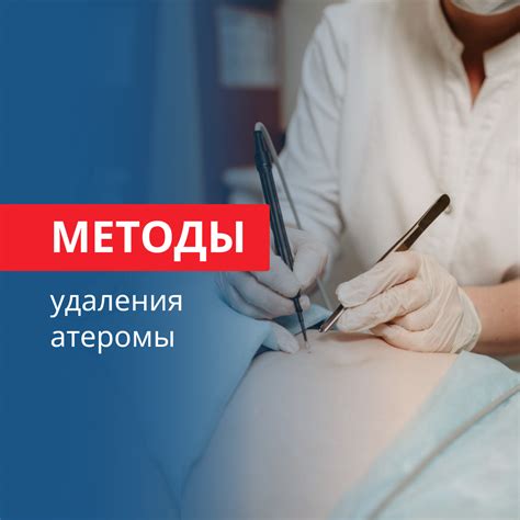 Эффективность лазерного метода удаления атеромы