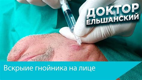 Эффективные методы лечения гнойника на ране