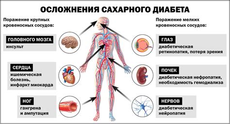  Причины возникновения сахарного диабета второго типа 